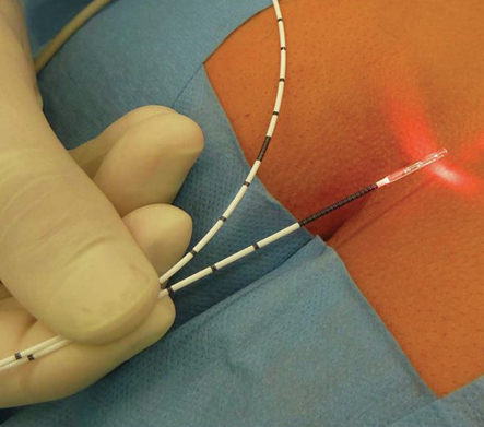 Laser Surgery