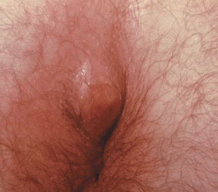 Swelling Around Anus
