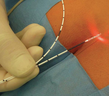 Laser Treatment of Anal Fistula