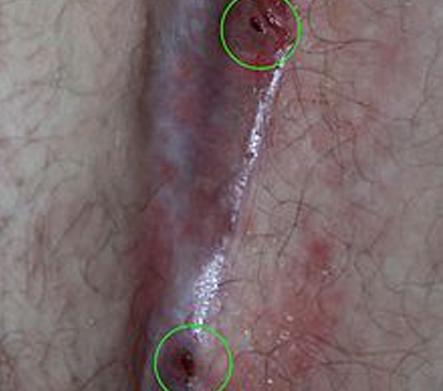 Mucus discharge