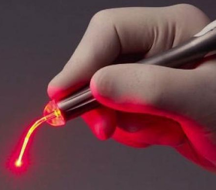 Laser Treatment of Anal Fissures