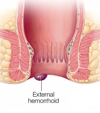 External Hemorrhoids