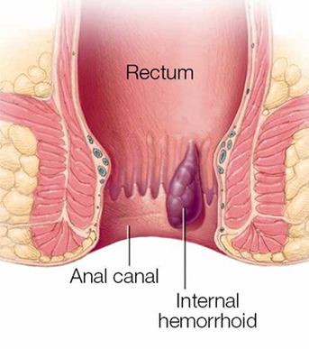 Internal Hemorrhoids
