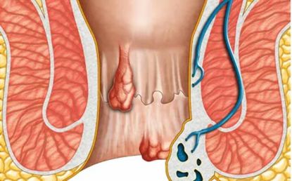 Introducing The Modern Piles Treatment In Delhi Without Surgery