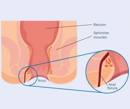 Fistula Treatment in Delhi