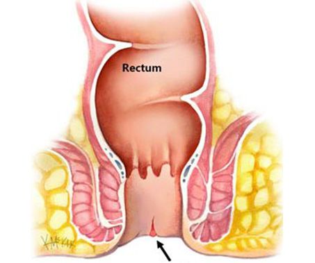 Fissure Treatment in Delhi