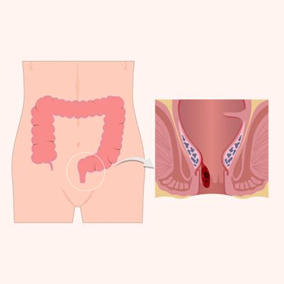 Piles Doctor in Delhi