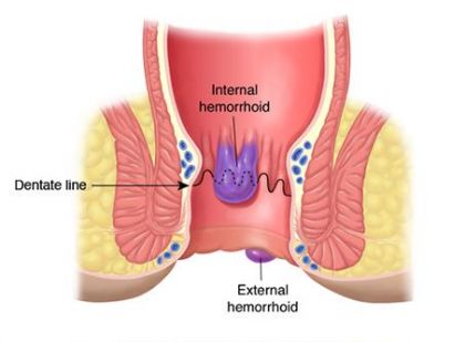 Piles Treatment Clinic in Delhi