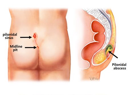Top Non-Surgical Piles Treatment Centre in Delhi